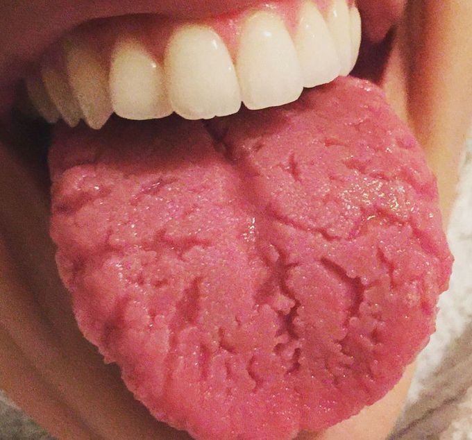 Fissured Tongue