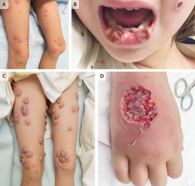 Pathergy in Neutrophilic Dermatosis