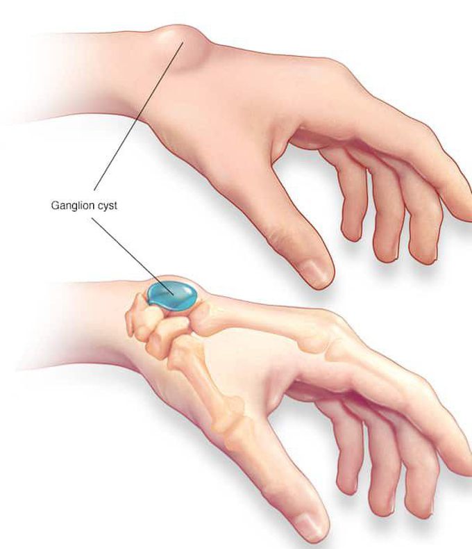 Ganglion Cyst