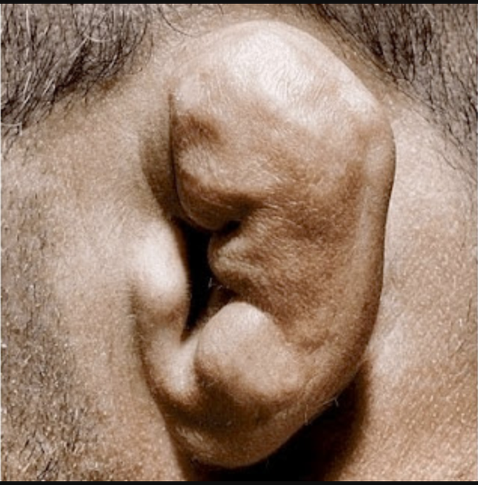 Identity the deformity and cause.