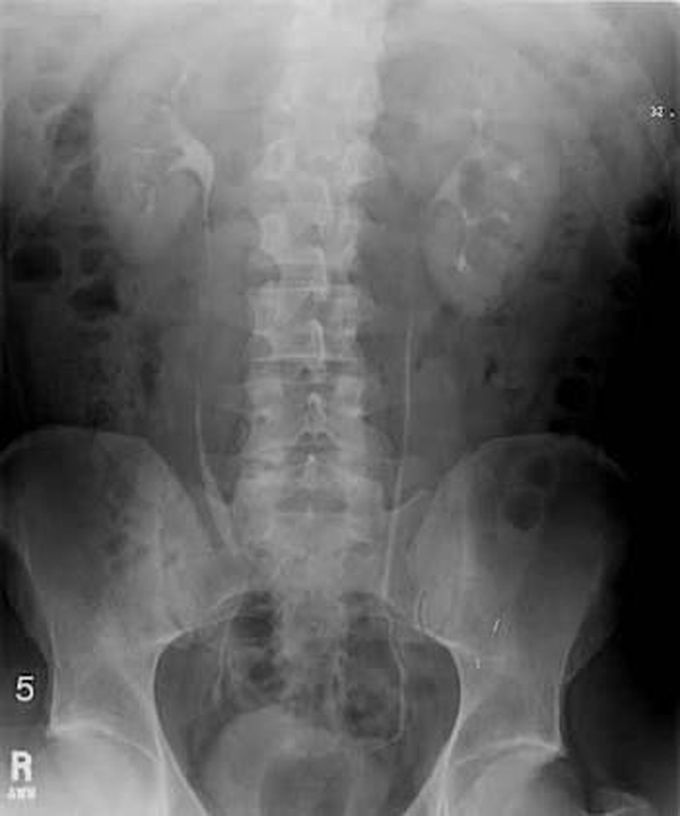 Intravenous Pyelogram