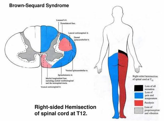 Brown sequard syndrome