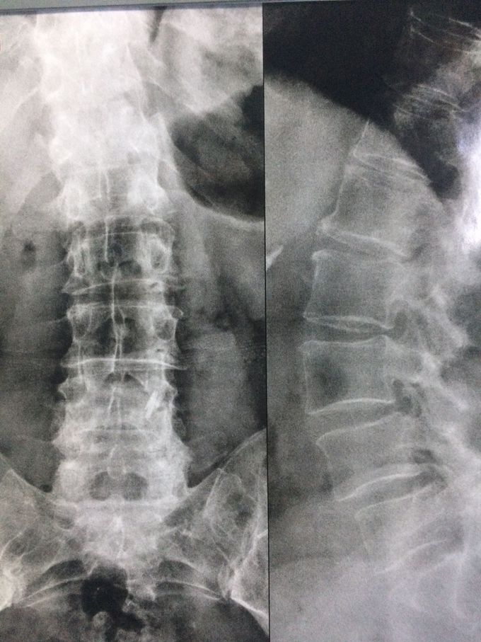 Bone alteration