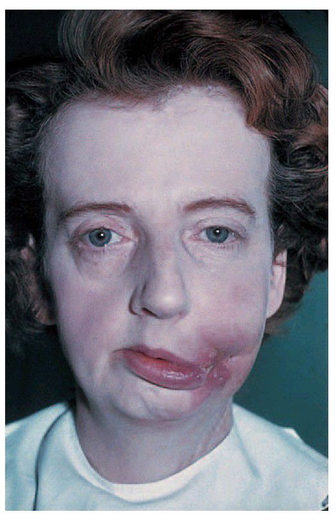 Oral carcinoma