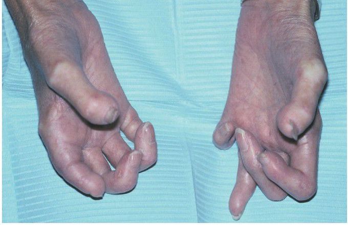 Systemic Sclerosis.