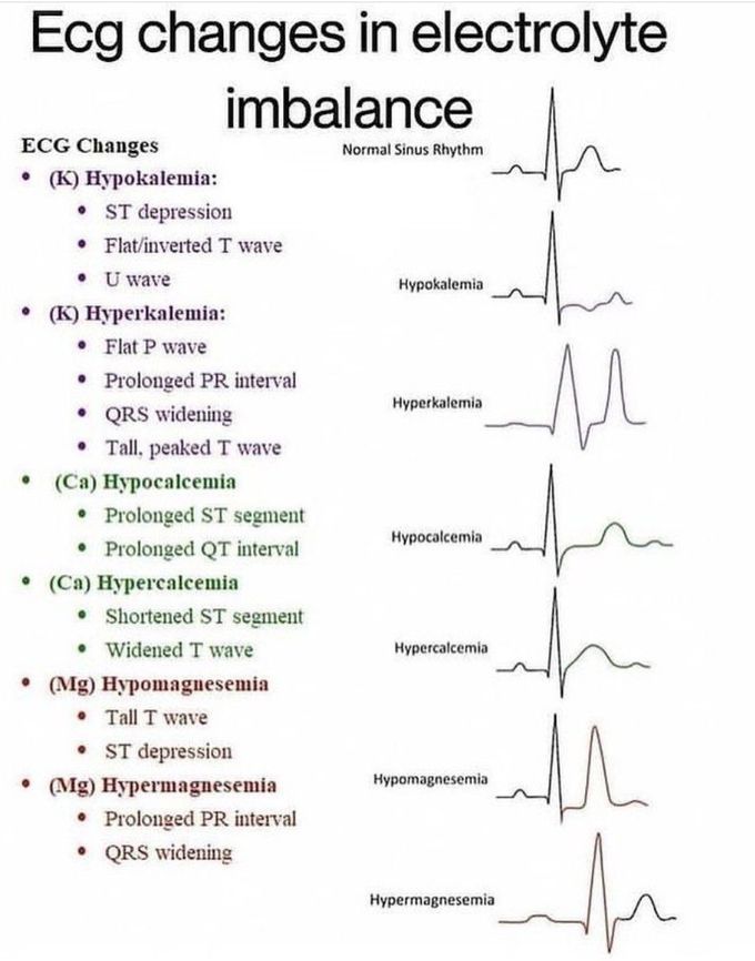 Electrolyte Imbalance and ECG Changes