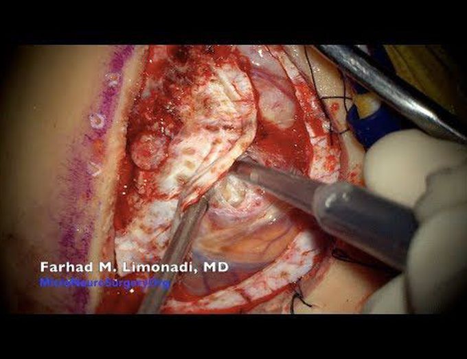Meningioma Surgery: Brain Surgery and Removal of a Large Brain Tumor  Near Motor Cortex
