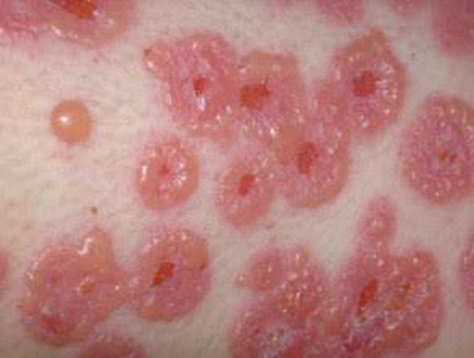 Linear IgA dermatoses
