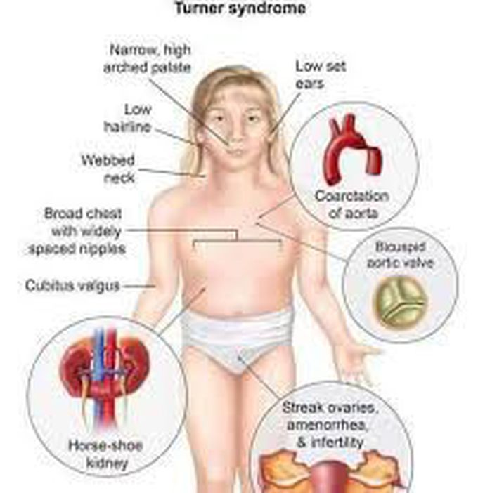 Turner's syndrome