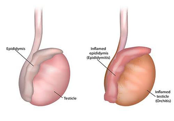 Epididymitis