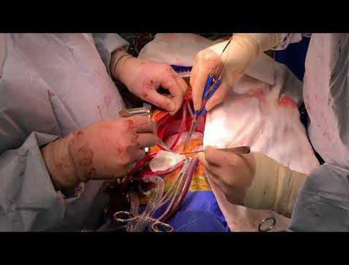 Cytoreductive Surgery for Right Ventricular Sarcoma