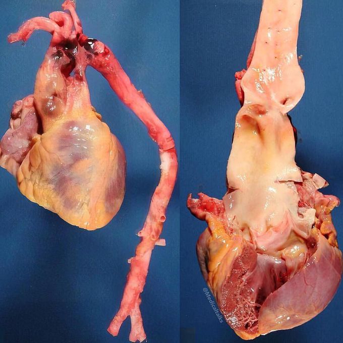 Aortic dissection!!!