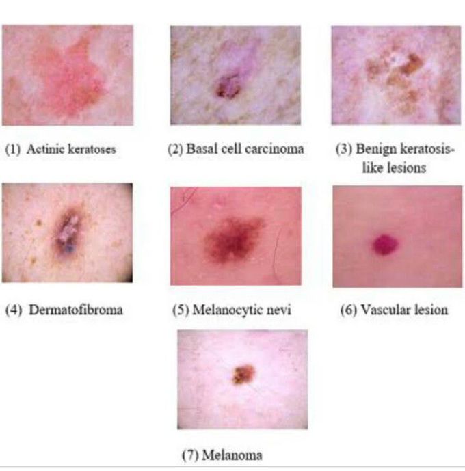 Types of skin lesion