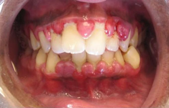 How do you treat gingivitis?