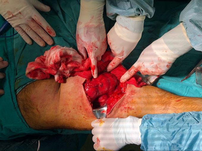 Femur posterior cyst hydatic