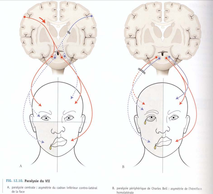 Facial palsy-peripheral vs central