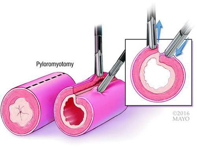 Pyloromyotomy