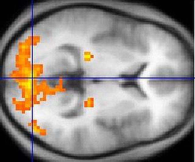 A fMRI scan showing regions of activation in orange, including the primary visual cortex