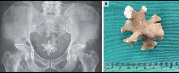 Jackstone Calculus in the Bladder