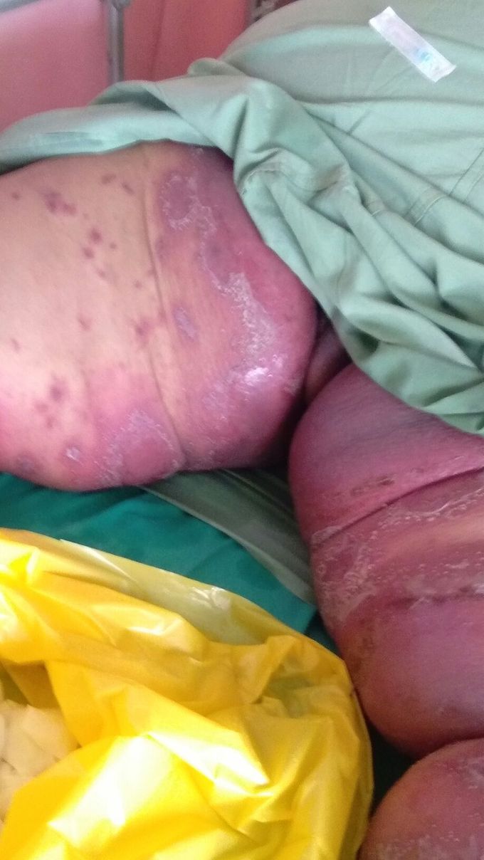 Particular Candidiasis