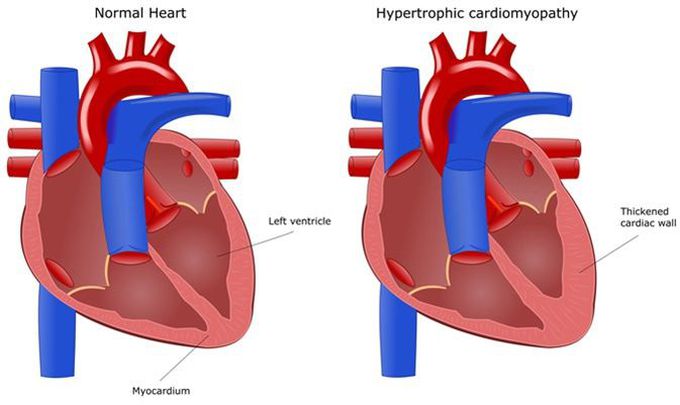 Hypertrophic Cardiomyopathy