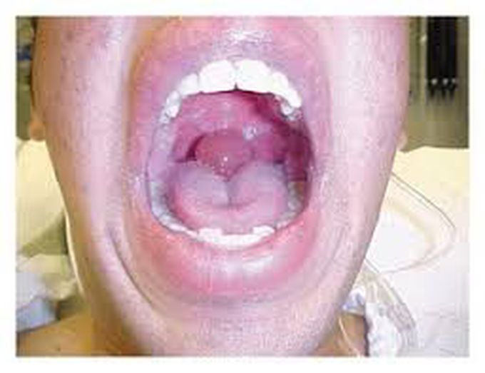 Quinckes disease symptoms