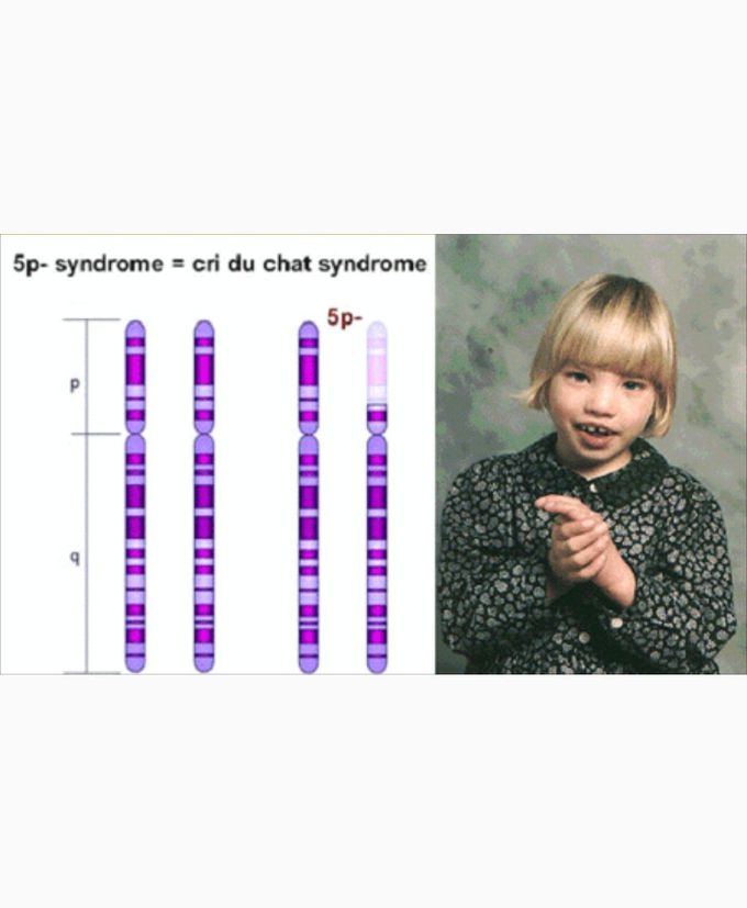 Cri du chat syndrome