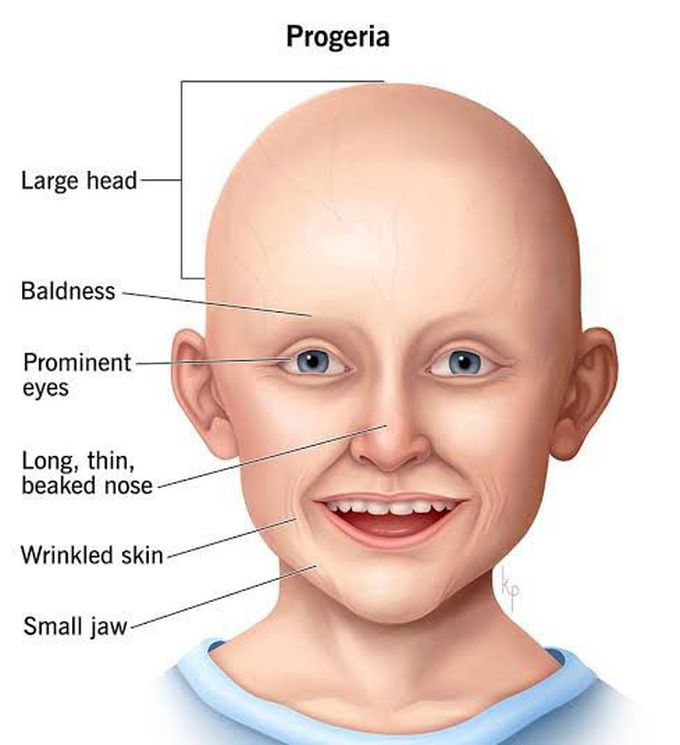 These are the symptoms of Progeria syndrome