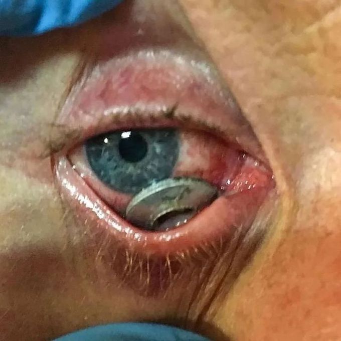 An Intraocular foreign body