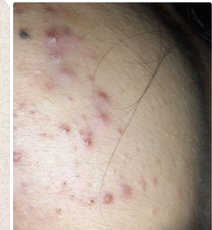What's your diagnosis???? Pimples on cheek