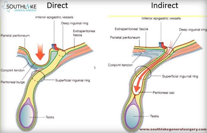 Direct vs indirect inguinal hernia