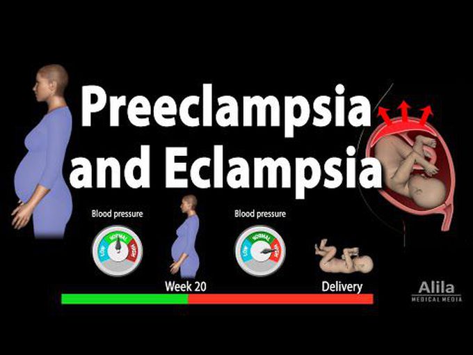 Preeclampsia and Eclampsia