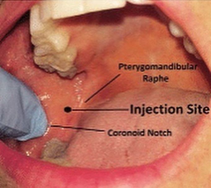 Injection site for mandibular block