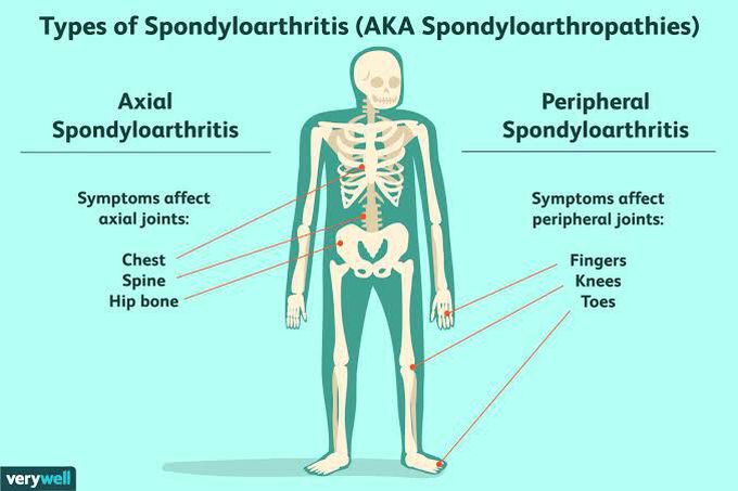 Spondyloarthritis- Types