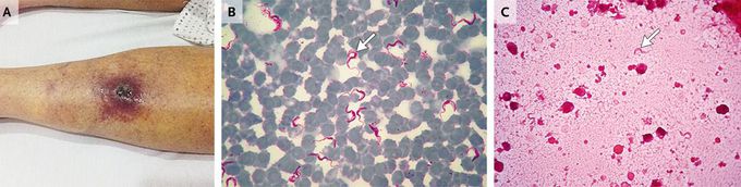 African Trypanosomiasis in Argentina