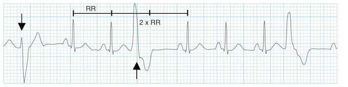 Premature Ventricular Complexes (PVCs)