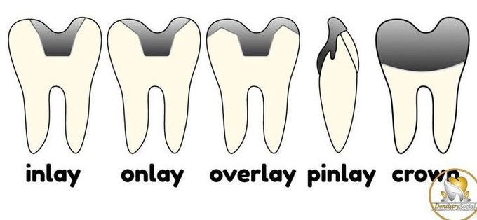 Types of Restorative Prosthesis