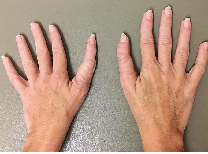 Triphapangeal thumb