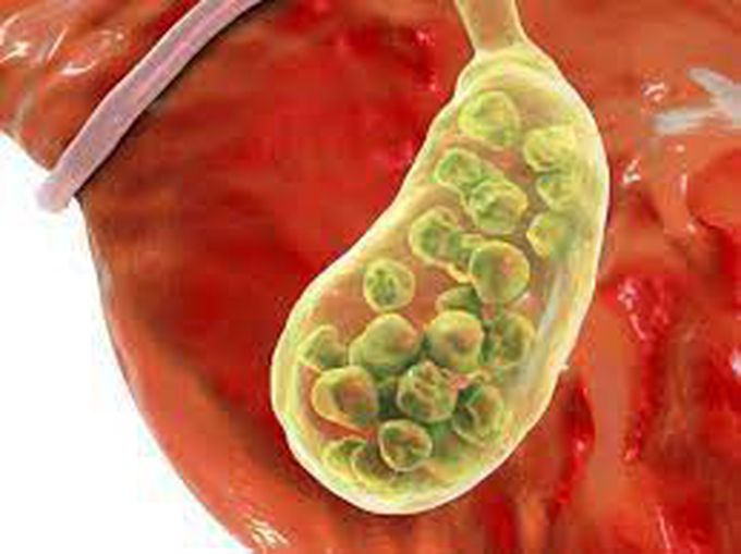 Causes of gall bladder sludge