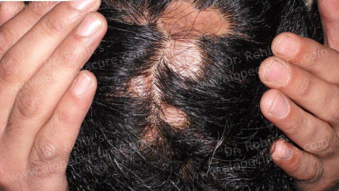 Cicatricial Alopecia.