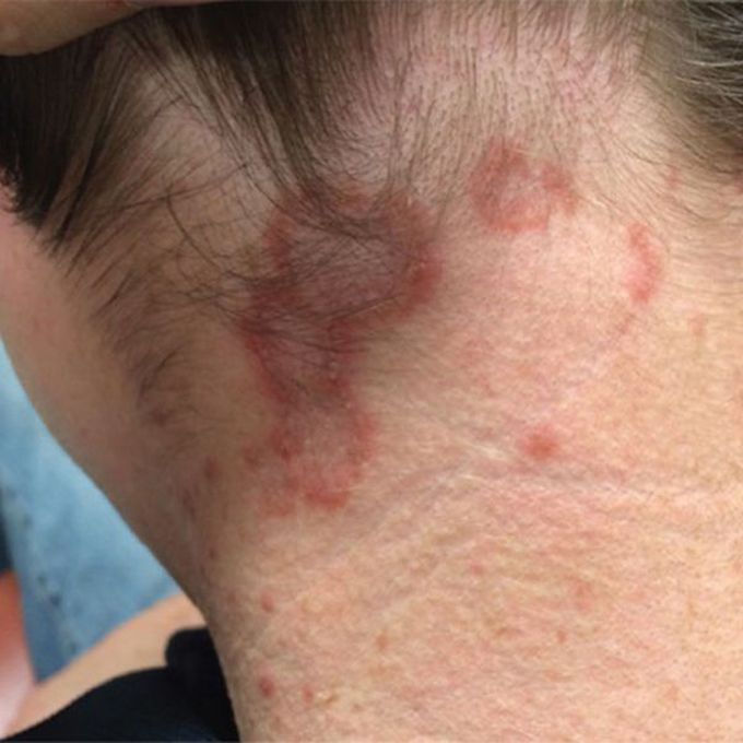 What is the aetiology of this rash?