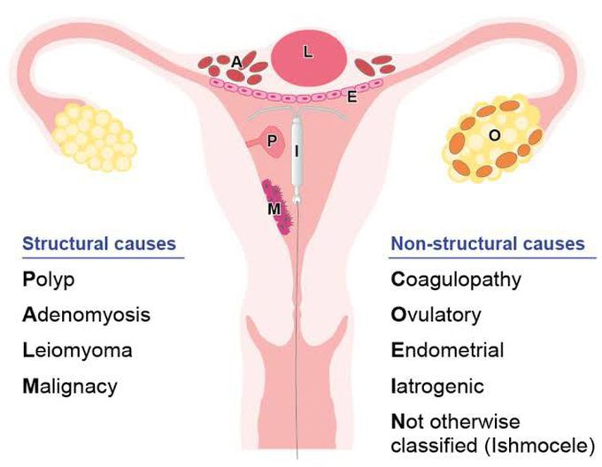 Dysfunctional uterine bleeding