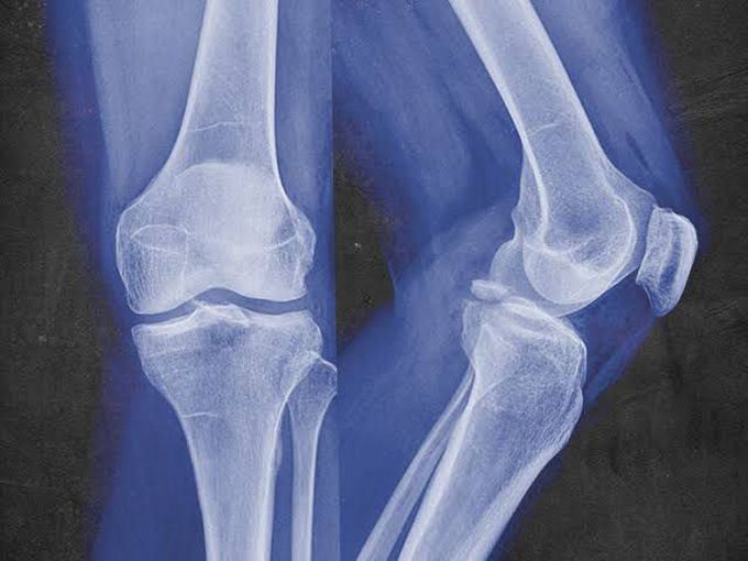 What causes avulsion fracture?