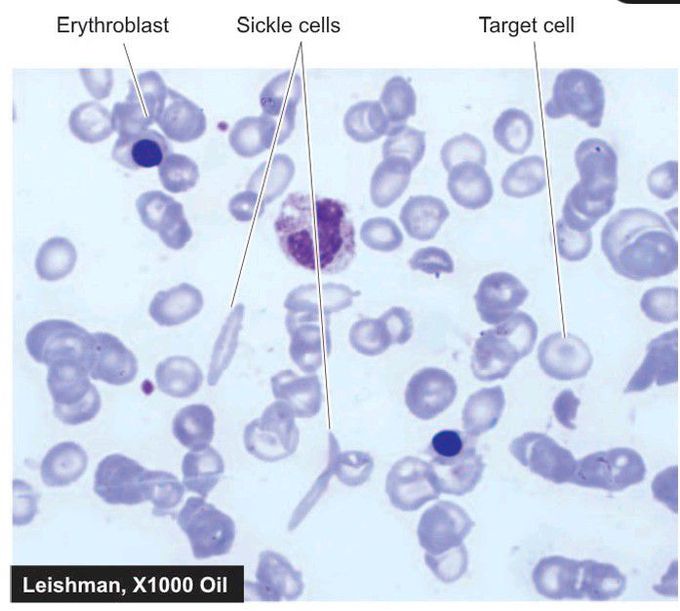 Sickle cell anaemia.