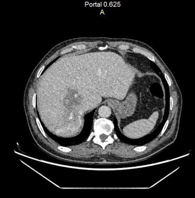 Right extended Hepatectomy