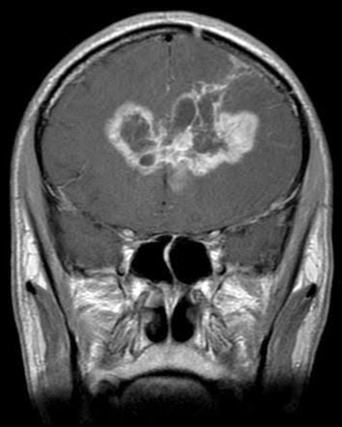 Butterfly glioblastoma