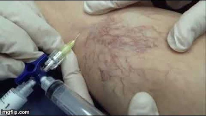 Varicose vein treatment sclerotherapy