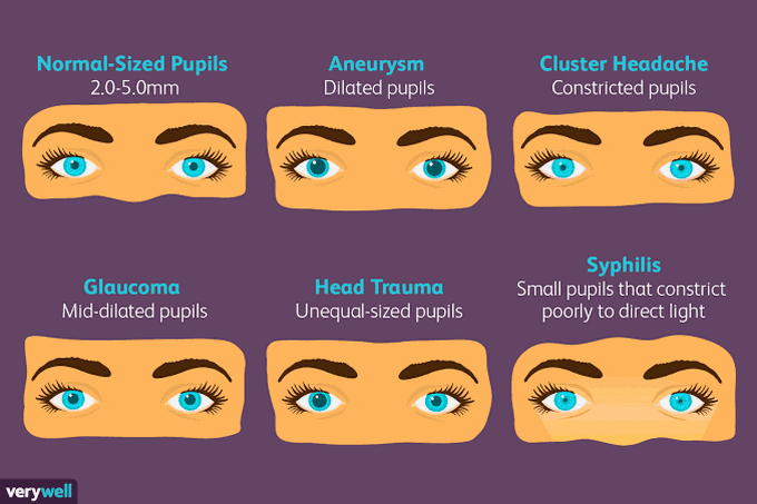 Abnormal Pupils