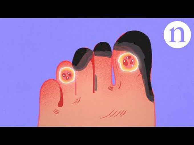 Critical Limb Ischemia-Animation