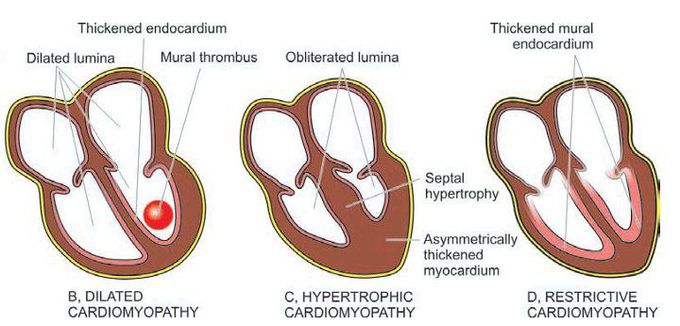 Idiopathic cardiomyopathies.